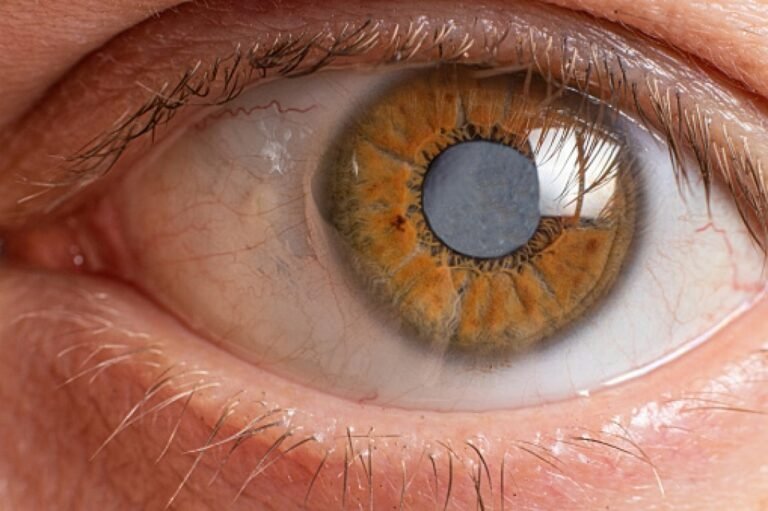 UBSs em Parnamirim estão recebendo pacientes para avaliação e triagem de glaucoma UBSs em Parnamirim estão recebendo pacientes para avaliação e triagem de glaucoma