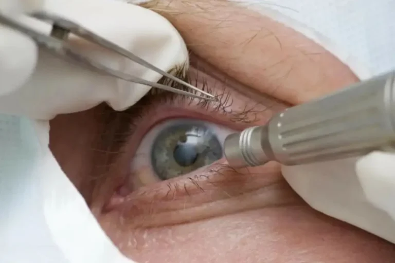 Cirurgia para mudar cor dos olhos pode causar danos irreversíveis Cirurgia para mudar cor dos olhos pode causar danos irreversíveis